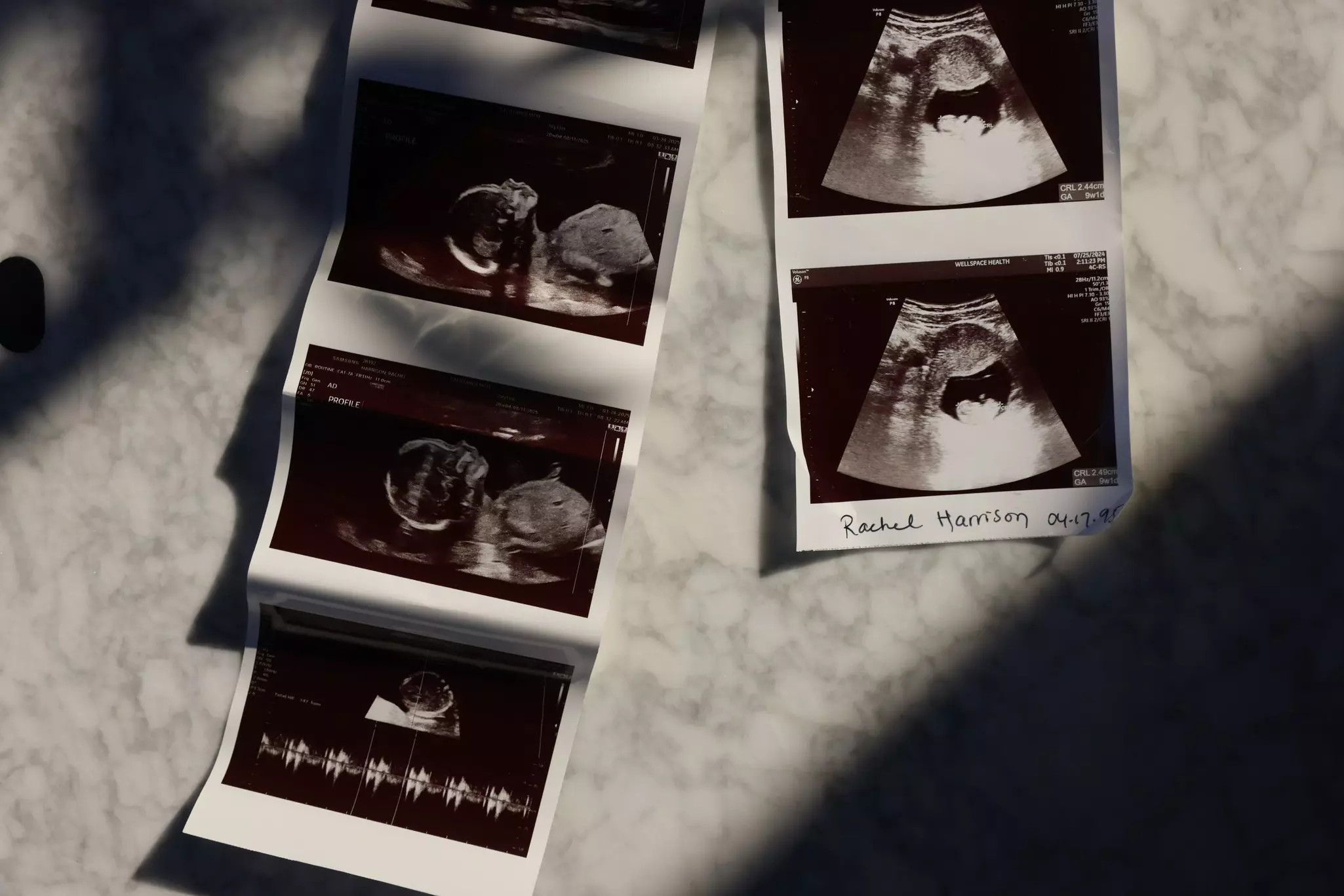 Pregnant in California? What Catholic hospital rules can mean in an emergency